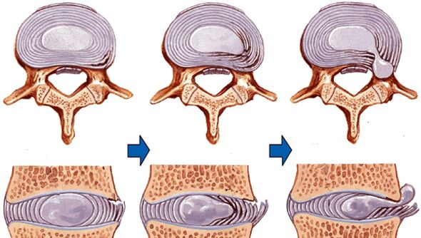 нараняване на гръбначния стълб при остеохондроза