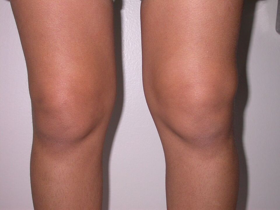 подуване на коляното поради остеоартрит