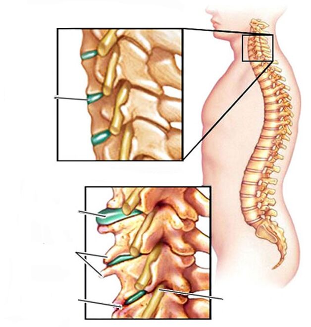 остеохондроза и здрав шиен отдел на гръбначния стълб