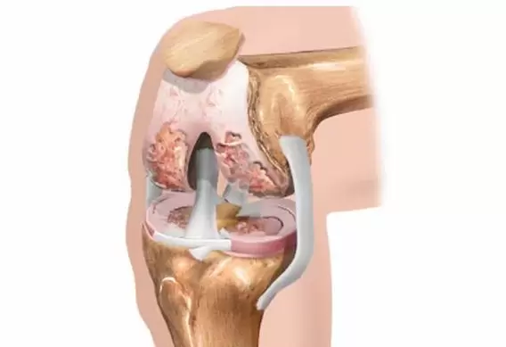 артроза на коляното