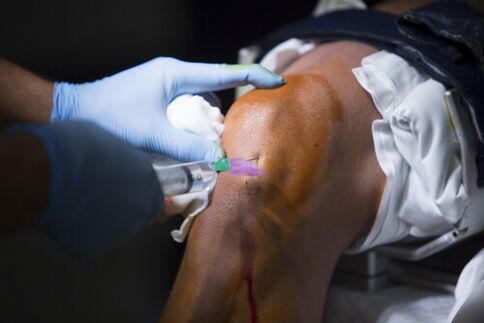 Инжекции в колянната става за артроза