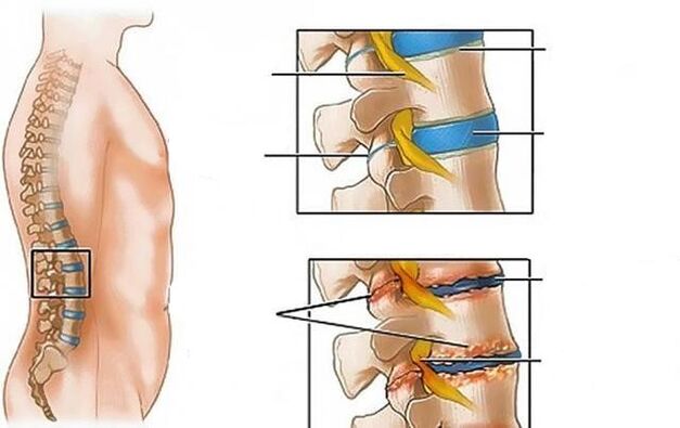 остеохондроза на лумбалната част на гръбначния стълб причиняват болки в гърба