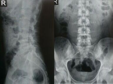 рентгенова снимка на лумбалната част на гръбначния стълб